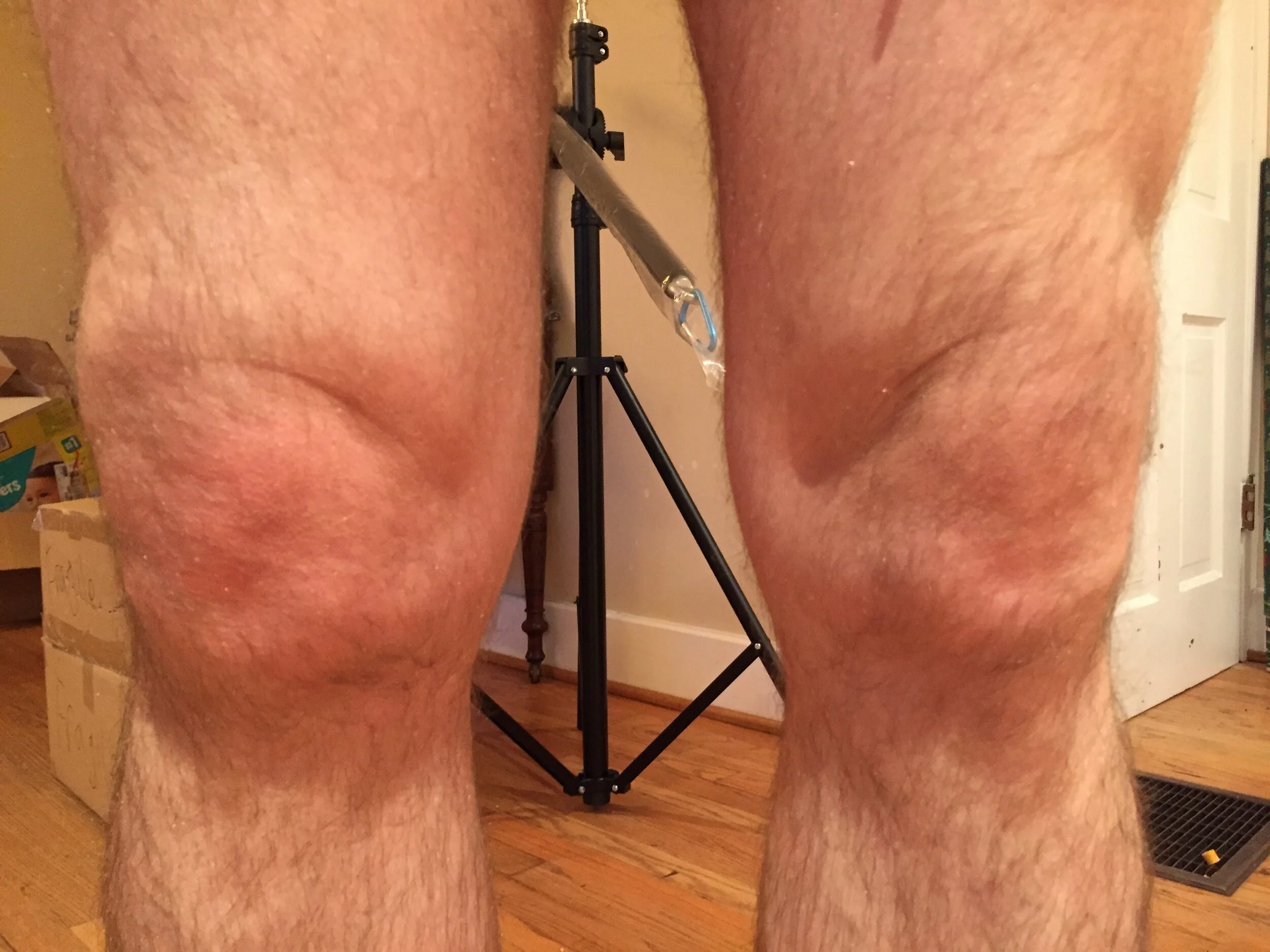 Osteoarthritis in the knees - what it looks like in action